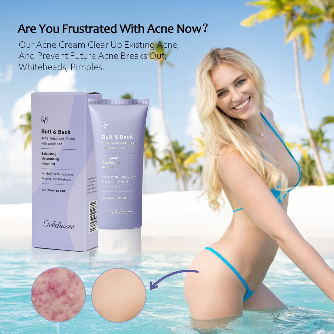 Back Acne Treatment, Butt Acne Clearing Treatment, Body Acne Treatment with A...