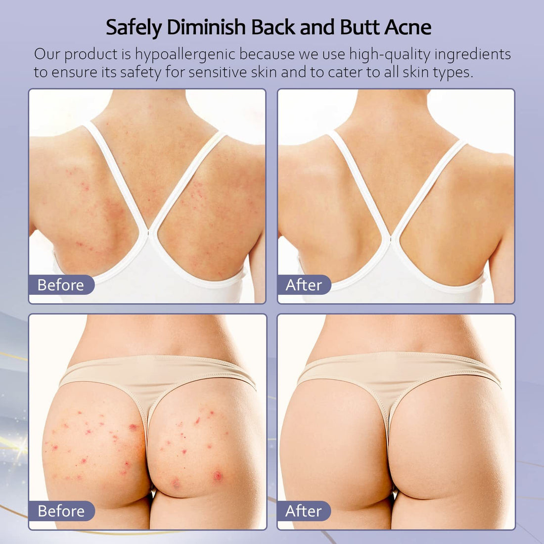 Back Acne Treatment, Butt Acne Clearing Treatment, Body Acne Treatment with A...