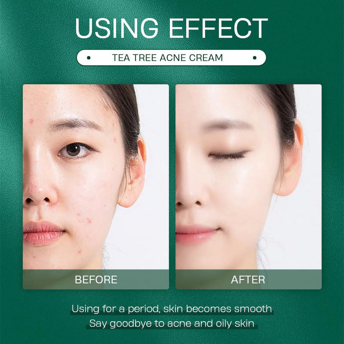 Tea Tree Oil Face Cream Acne Cream - for Oily, Acne Prone Skin, Extra Soothing & Nourishing 